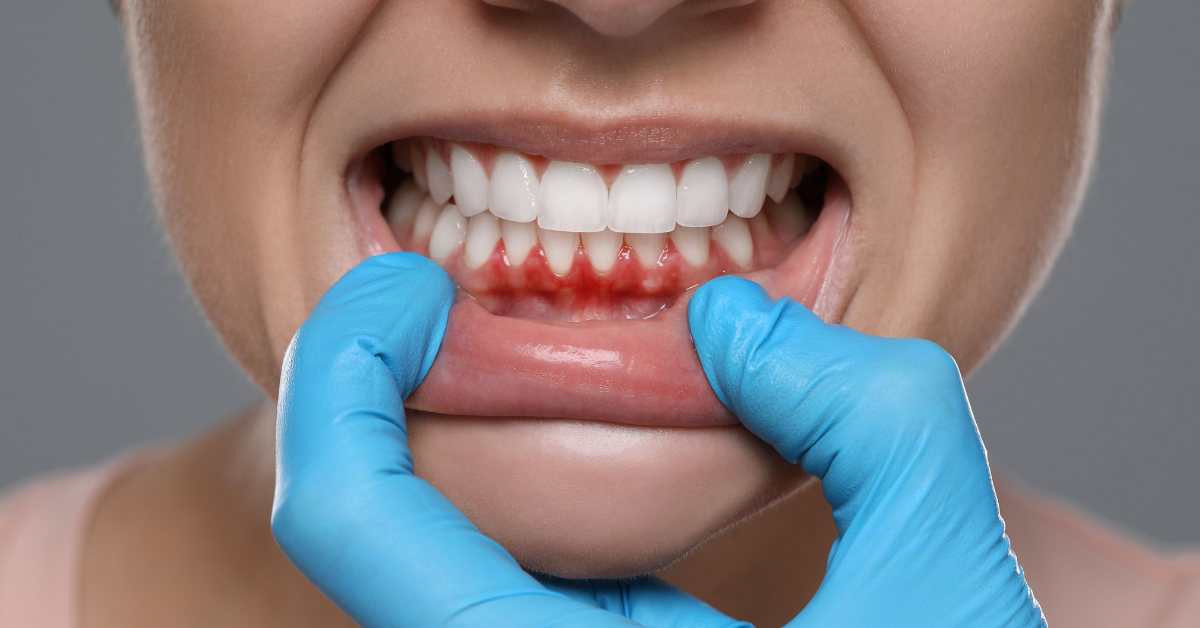 7 Warning Signs of Gum Disease and What To Do About Them