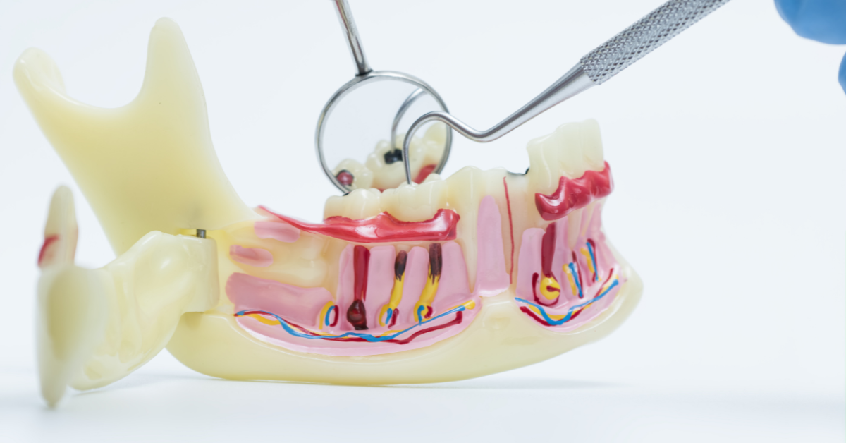 Cavities and Tooth Decay Symptoms and Causes