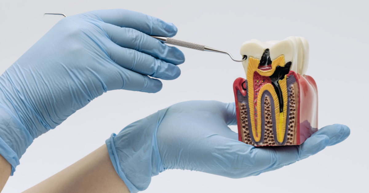 Cracked Tooth and Seeking Treatment