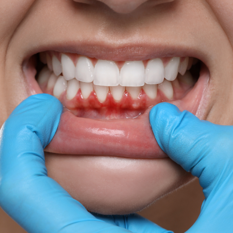 7 Warning Signs of Gum Disease and What To Do About Them