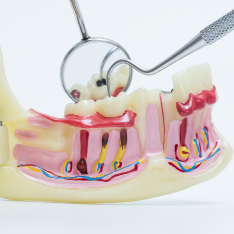 Cavities and Tooth Decay Symptoms and Causes