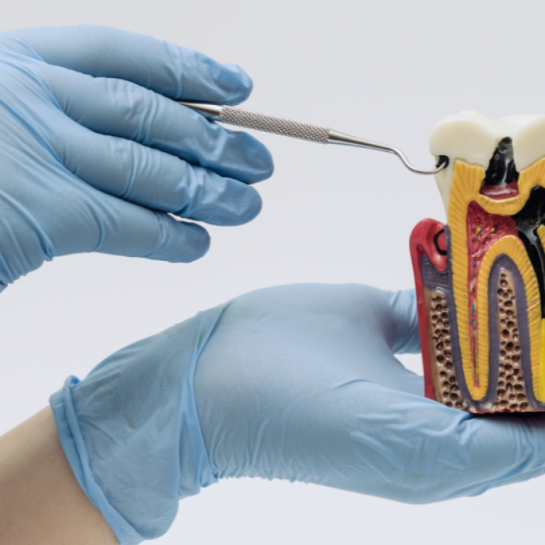 Cracked Tooth and Seeking Treatment