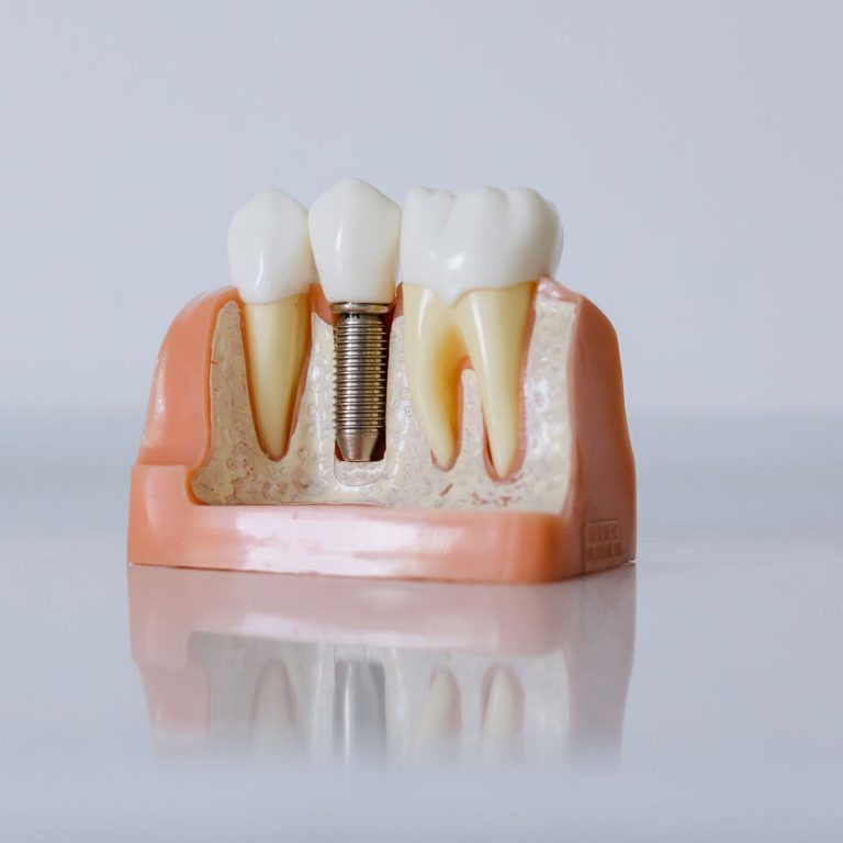 Dentist explaining dental implants with gum disease to patient